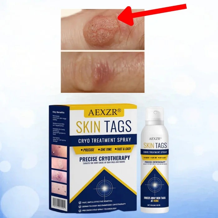 CryoFreezer — холодне видалення папілом і бородавок